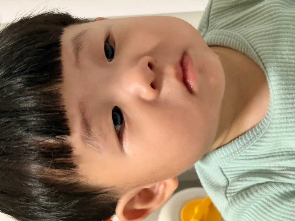 신생아 눈썹 노란 비듬, 지루성 피부염이 확장된 거예요